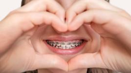 Kolik stojí rovnátka? Známe ceny, rozdíly v lokalitách i skryté výdaje